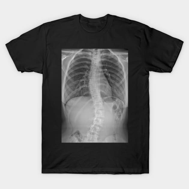 Scoliosis Xray T-Shirt by StarsHollowMercantile